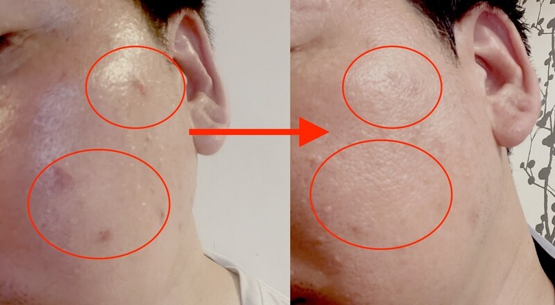 【実録】アラフィフの顔イボを皮膚科で治療したらどれくらいで取れるのか? 経過や費用などのリアルを赤裸々にお伝えしよう