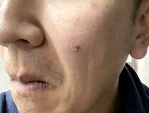 【悪性？】顔のシミが徐々に濃くなり立体化 → ドキドキしながら皮膚科に行ってみた結果…