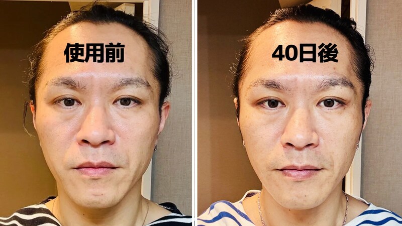 40日続けた結果…クチトレでほうれい線は消えたのか