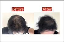 【検証】薄毛がパーマをかけたら少しはフサフサに見えるのか？ 試してみたら衝撃の結末が！