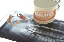 「インプラント」と「入れ歯」どっちを選ぶべき？ それぞれのメリット・デメリットと選び方のヒントを歯科医が解説