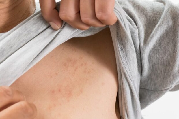 湿疹ができている人