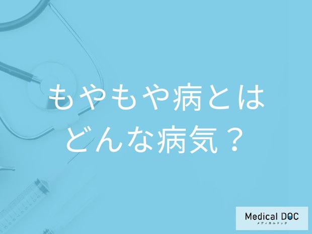 「もやもや病」とはどんな病気？発症するとどんな症状が現れる？医師が解説！