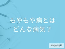 「もやもや病」とはどんな病気？発症するとどんな症状が現れる？医師が解説！