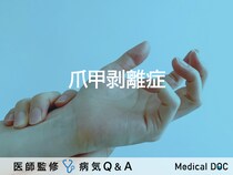 「爪甲剥離症」になりやすい人の特徴はご存知ですか？医師が監修！