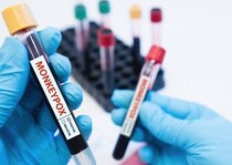 【サル痘】WHOが世界の公衆衛生に「中程度のリスク」と見解