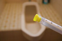 血尿を伴う病気を泌尿器科医が解説 尿路結石･膀胱炎･膀胱がん以外にどんな疾患が起こりうる?