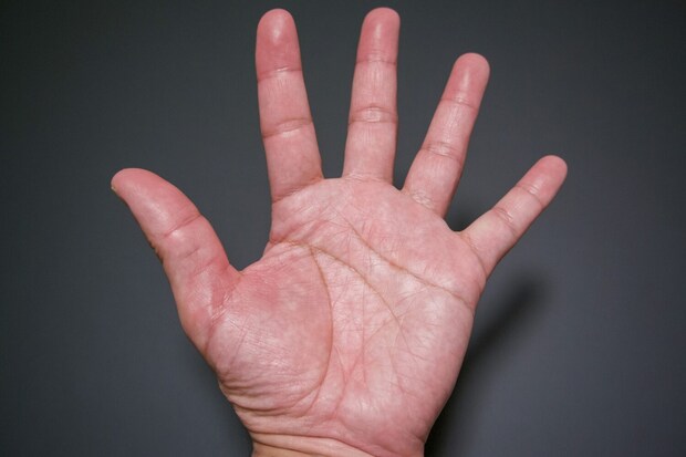 多汗症の原因と治療法