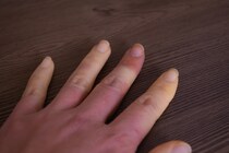 「膠原病」とは？症状・原因についても解説！