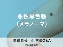 「悪性黒色種（メラノーマ）」とは？見分け方・症状・原因・治療法も解説！