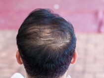 AGA治療の飲み薬、ミノキシジルには副作用も！ 理解の上でリスク管理できる医師と治療しよう