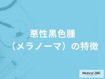 「悪性黒色種（メラノーマ）」の初期症状はご存知ですか？【医師監修】