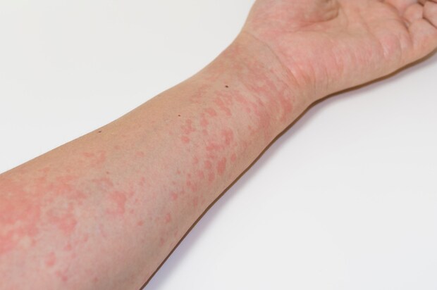 「お酒を飲むと体に赤い斑点」ができる原因はご存知ですか？