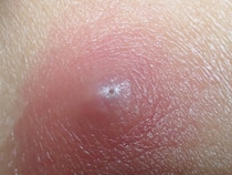 「炎症性粉瘤」とは？症状・原因・治療方法も解説！【医師監修】