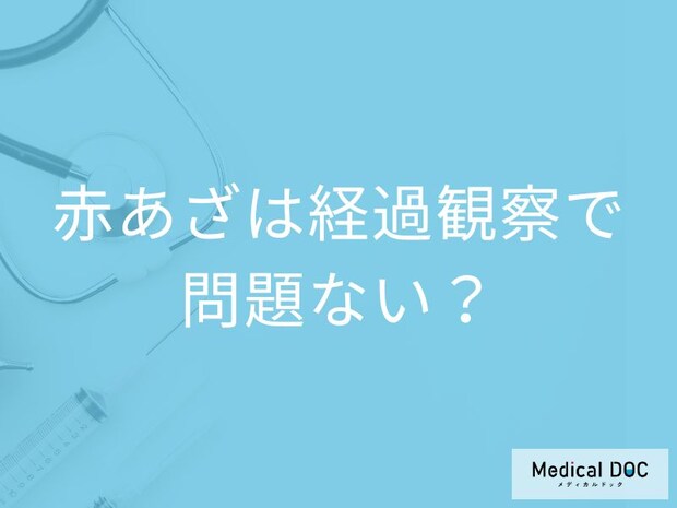 子どもの赤あざ「経過観察で問題ない」は過去の話? 早めに治療するメリットを医師が解説!