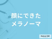 「顔にできたメラノーマ」とほくろとの見分け方はご存知ですか？医師が解説！