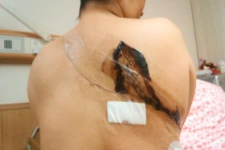 5度に及ぶ再発･転移と現在も続く後遺症の多さ