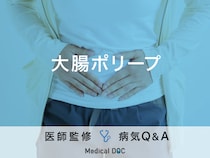 「大腸ポリープ」を発症すると現れる症状・原因はご存知ですか？医師が監修！