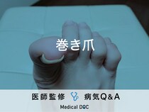 「巻き爪」になる原因はご存知ですか？医師が監修！