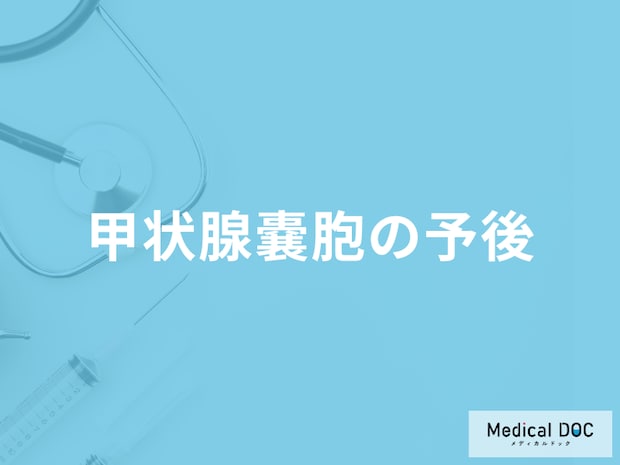 「甲状腺嚢胞」と診断されたときの注意点はご存知ですか？予後について解説！