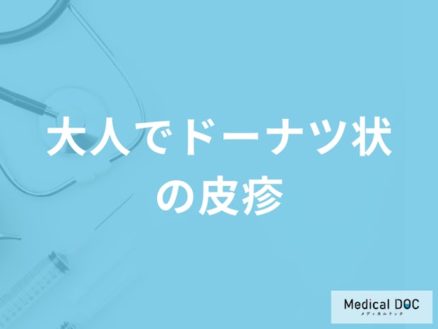 「大人でドーナツ状の皮疹」 ができる原因はご存じですか？考えられる病気も解説！