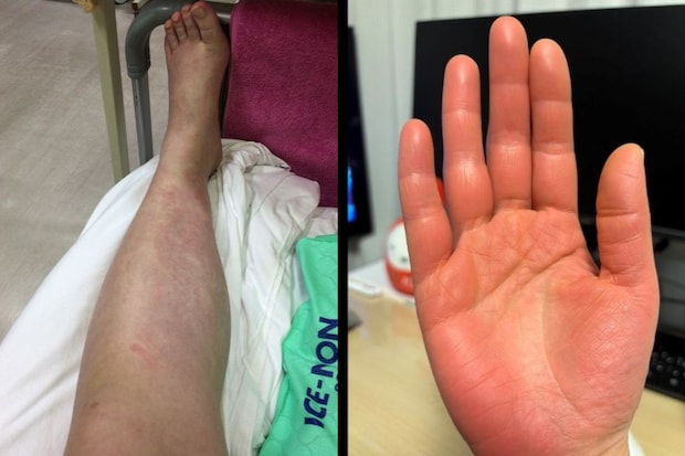 初回入院当日_皮膚筋炎の症状として下腿全体の腫れ