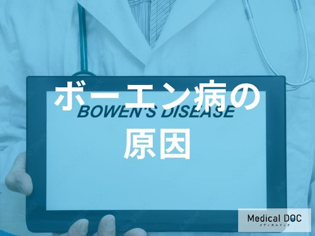 「ボーエン病を発症しやすい2つの原因」はご存じですか？医師が監修！