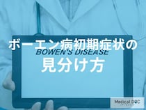 「ボーエン病初期症状」と他の皮膚疾患の見分け方とは？注意点も解説！【医師監修】
