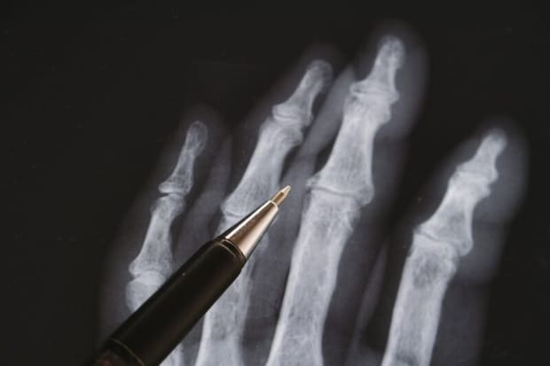 手のX線写真36
