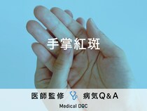 「手掌紅斑（しゅしょうこうはん）」ができる原因はご存知ですか？医師が監修！