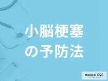 「小脳梗塞の予防法」は何を注意すれば良いのかご存知ですか？医師が徹底解説！
