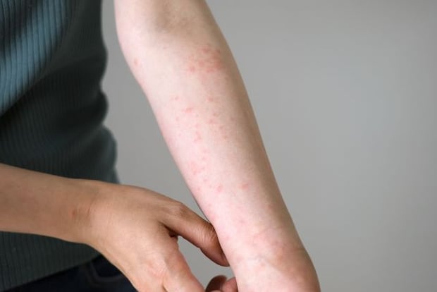 突然の疱疹状膿痂疹