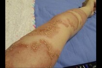 【闘病】「膿」を持ったブツブツと激痛は体中に広がり、“ミイラ”になった私は寝たきり…