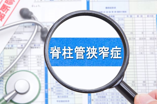 そもそも脊柱管狭窄症はどのような疾患なのか？