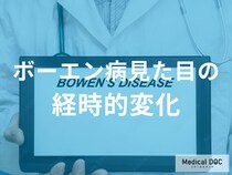 「ボーエン病が進行する」と皮膚はどのように変化するのか？医師が監修！