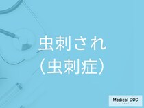 「蚊に刺されやすい人」の共通点を医師が解説 虫刺されで起こる怖い感染症とは