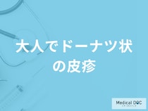 「大人でドーナツ状の皮疹」 ができる原因はご存じですか？考えられる病気も解説！