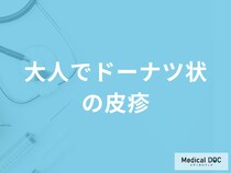 「大人でドーナツ状の皮疹」 ができる原因はご存じですか？考えられる病気も解説！