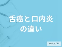 「舌癌と口内炎の違い」は舌のどこをチェックすれば良い？見分け方を医師が解説！