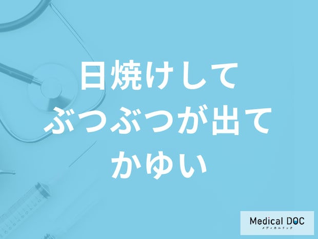「日焼けしてぶつぶつが出てかゆい」ときの対処法は?日焼け止めについても解説!