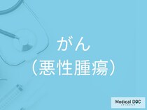 「がん」の初期症状を医師が解説 無症状のうちに進む危険な特徴とは