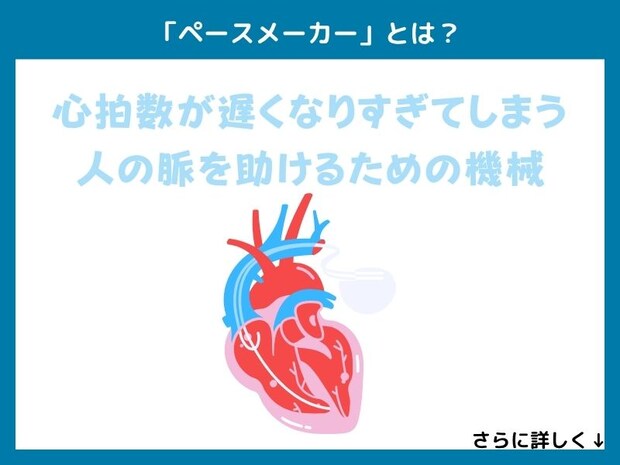 「ペースメーカー」とは？