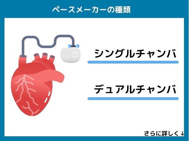ペースメーカーの種類