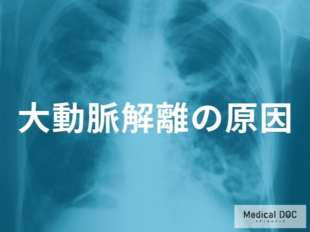 「大動脈解離」のリスクが急上昇する理由とは 高血圧と加齢が危険なワケを医師に聞く