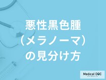 「悪性黒色腫（メラノーマ）と良性の見分け方」はご存じですか？医師が解説！