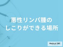 「悪性リンパ腫のしこりができる場所」はご存知ですか？【医師監修】