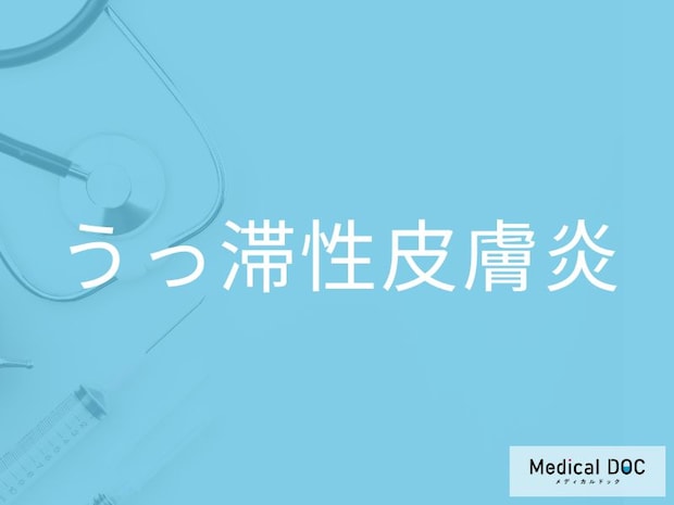 「うっ滞性皮膚炎」の5つの前兆をご存じですか？ 足のむくみは早期受診のサイン？【医師監修】