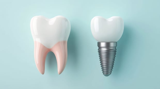 インプラント治療後に使用するマウスピースについて