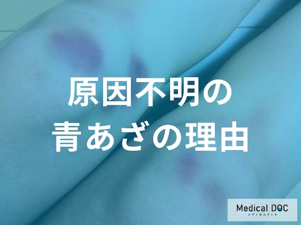 『原因不明のあざ』に潜む“血液”と“血管”の危険サイン 「ぶつけた記憶ないけど…」