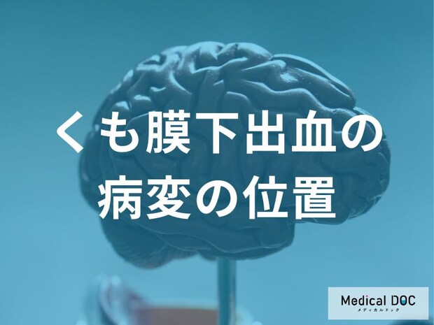 「くも膜下出血の出血源」はどこ？ 脳動脈瘤ができやすい“危険な場所”とは【医師監修】